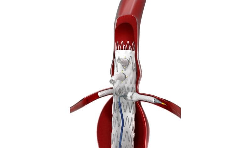 Illustration of an aortic stent graft inside a blood vessel, showing its placement and structure within the artery.